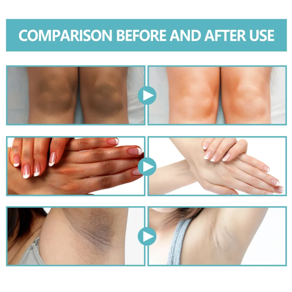 Black Acanthoderma Moisturizing Repair Cream Brightening Armpits Arms Knees Lightening Emulsion Brighten Skin Body Care Cream - Image 2