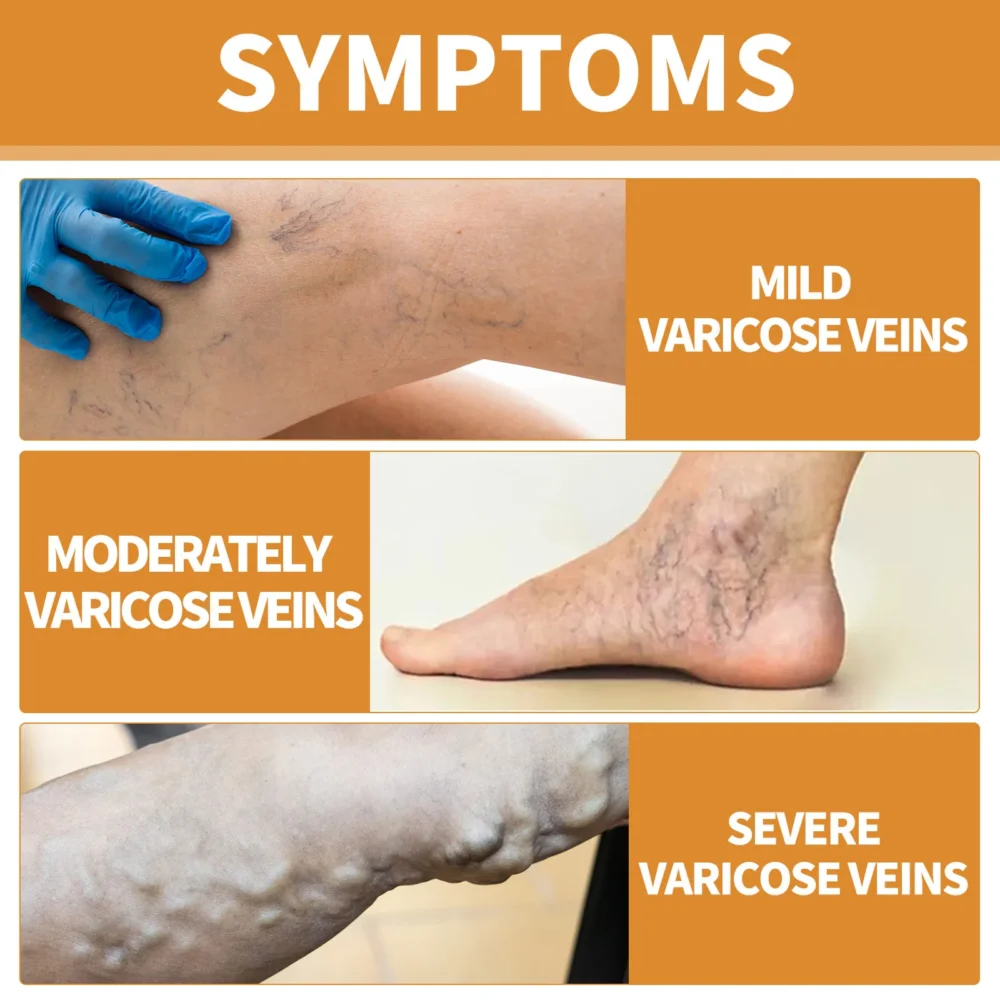 Leg Treatment Cream Reducing Varicose Veins Remove Redness Repair Phlebitis Relieves Bulge Improving Circulation Body Care Cream - Image 2