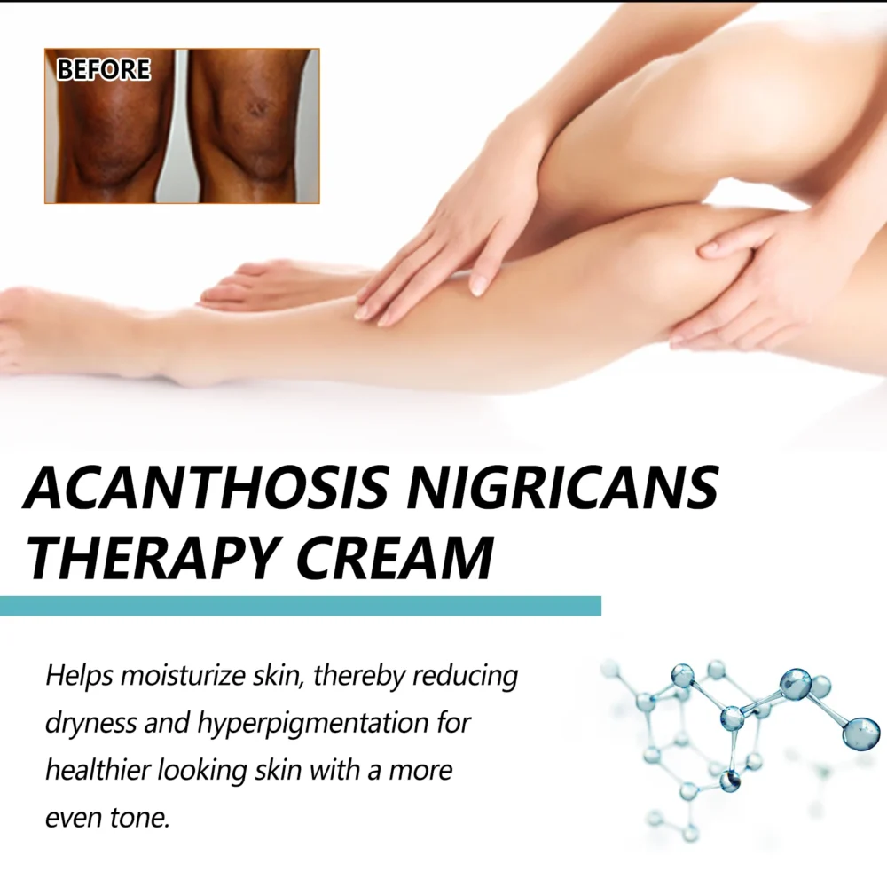 Black Acanthoderma Moisturizing Repair Cream Brightening Armpits Arms Knees Lightening Emulsion Brighten Skin Body Care Cream - Image 6